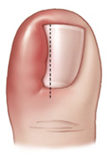 ingrown toe nail cyprus 1.jpg